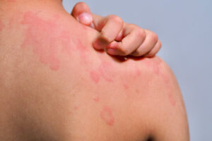 Urticaria